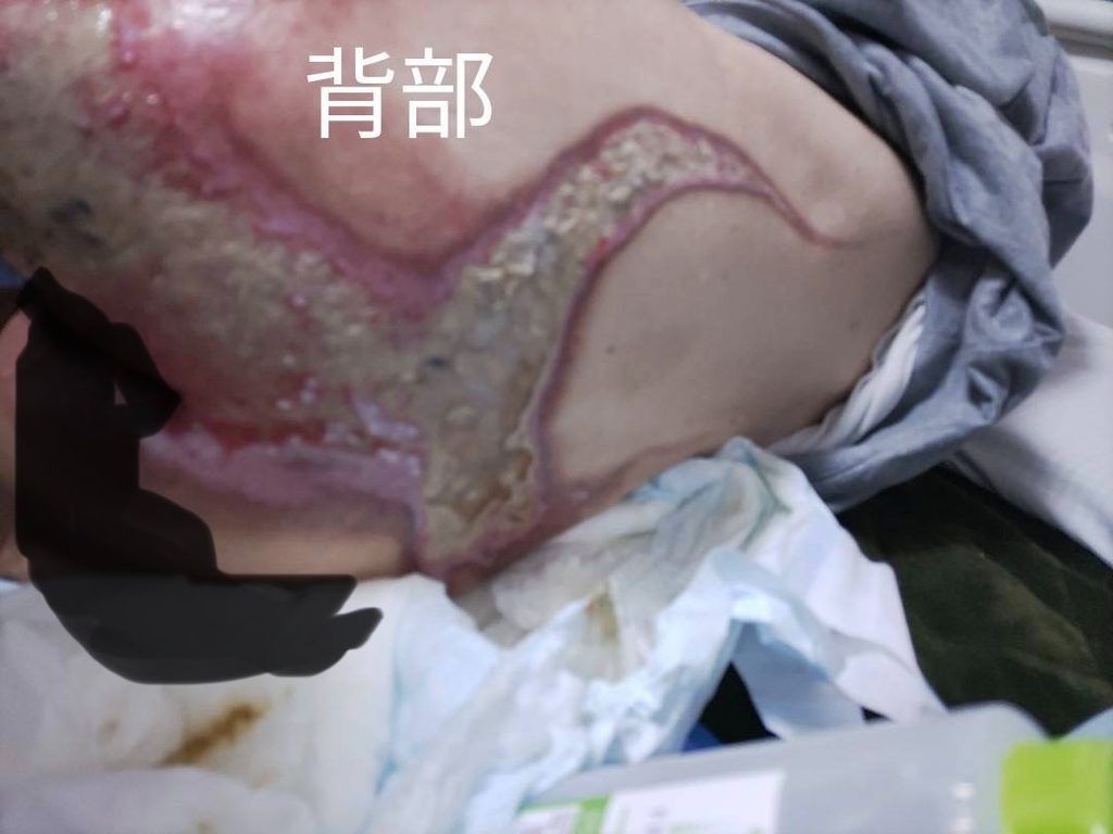 Ⅲ度熱傷受傷後1か月半後の背部の写真(壊死組織が残っており浸出液の多い状態)