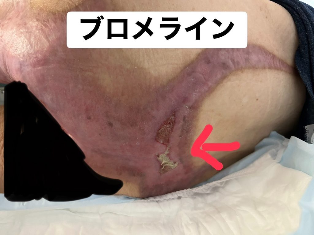 Ⅲ度熱傷受傷後3か月半後の背部(上皮化がすすんでいる状態)
