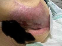 Ⅲ度熱傷受傷後4か月半後の臀部(上皮化した状態)