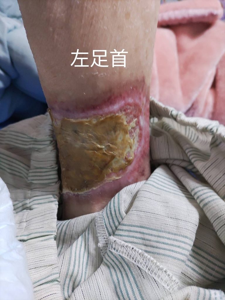Ⅲ度熱傷受傷後1か月半後の足首(壊死組織の残存した状態)