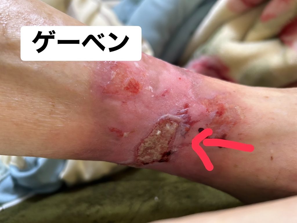 Ⅲ度熱傷受傷後3か月半後の足首(上皮化がすすんでいる状態)